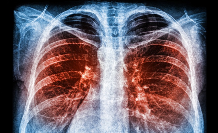 NGS-guided antimicrobial adjustments improve outcomes for patients with severe pneumonia