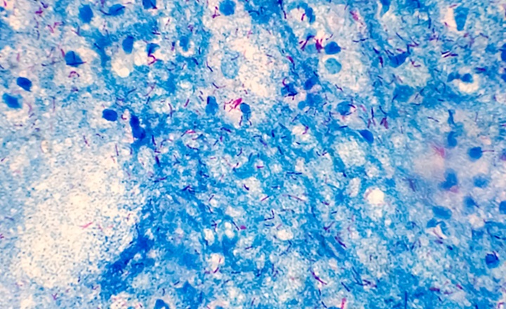 WGS for predicting isoniazid resistance in MTb Complex