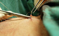 Surgical site infections following laparotomy or neurosurgery