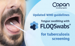 Tongue swabbing with FLOQSwabs for TB testing